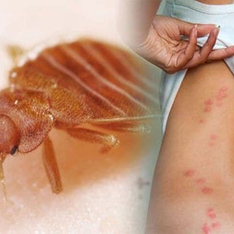 bedbugs on human