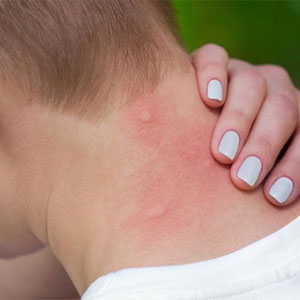 mosquitoes_skin